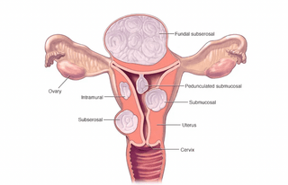 Types of Fibroids Explained: How Fibroid Location Impacts Your Symptoms, Pain, and Periods - My Happy Flo